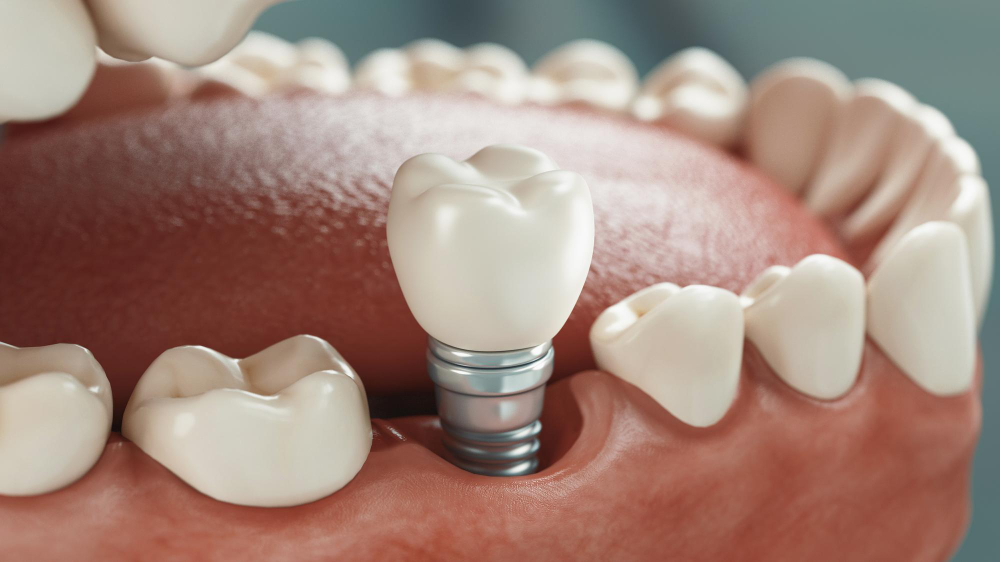 Dental Implants in Indialantic